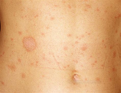 Pityriasis Rosea Stages Symptoms Causes Treatment And Prevention Of