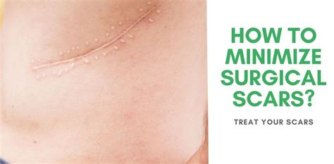 How To Minimize Surgical Scars Treat Your Scars