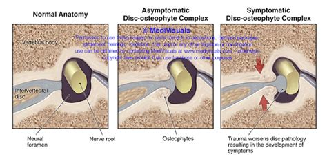 Disc Osteophyte Complex Explained Medivisuals Inc Medivisuals Inc