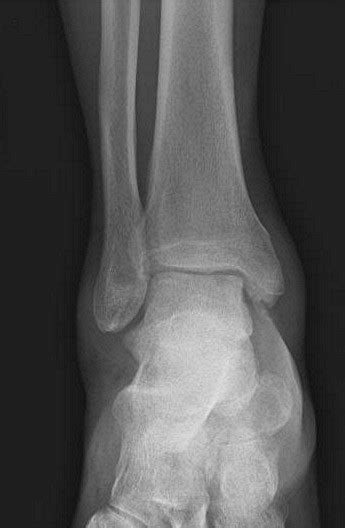 Open Dislocation The Foot And Ankle Online Journal