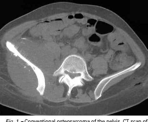 Figure 1 From Imaging Of Malignant Bone Tumors Semantic Scholar