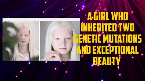 A Girl Who Inherited Two Genetic Mutations And Exceptional Beauty