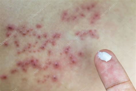 Raised Red Bumps And Blisters On Skin Stock Photo By ©hatchapong 110442536