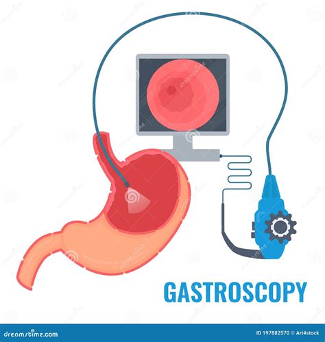 Gastroscopy Procedure Of Stomach Examination With Endoscope Stock