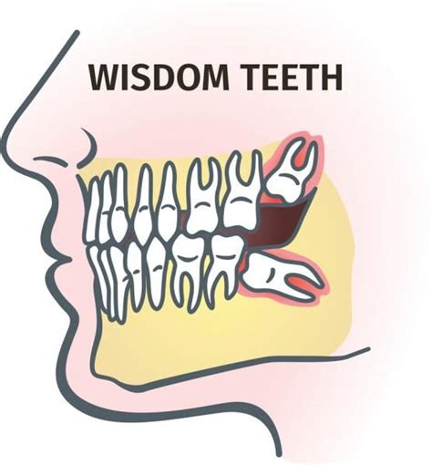 How Long Do Dissolvable Stitches Take To Dissolve Wisdom Teeth Dane101