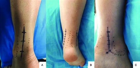 Surgical Approaches For Posterior Pilon Fractures A Posterolateral