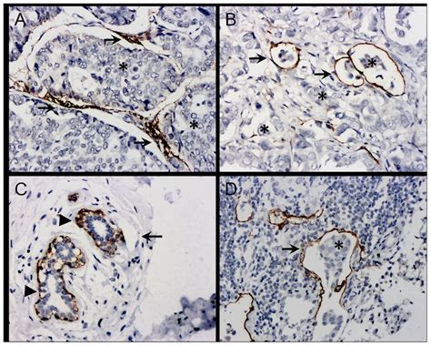 Immunohistochemical Staining Of D2 40 A Lymph Vascular Structures In