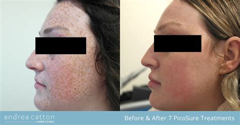 Laser Freckle Removal Uk Picosure Fla And Revlite Andrea Catton Laser