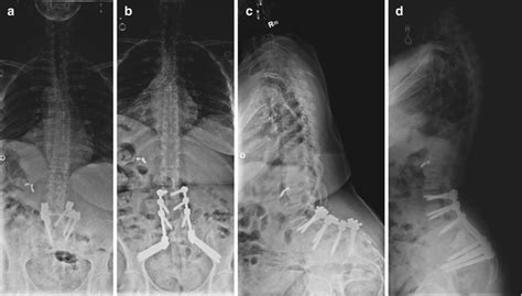 Distal Fixation For Adult Lumbar Scoliosis Indications And Techniques
