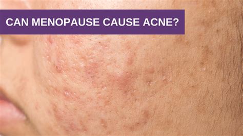 Can Menopause Cause Acne Genesis Gold Menopause