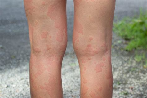 Red Spots On Legs Feet Dots Patches Not Itchy Pictures Causes