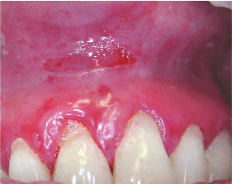 Atrophic Erosive Lichen Planus Oral Lichen Planus Is Usually Diagnosed