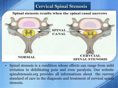 Ppt Surgery For Spinal Stenosis Powerpoint Presentation Free