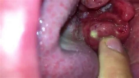 Tonsil Stones Tonsil Stone Removal Lots Of Weird Little Ones Youtube