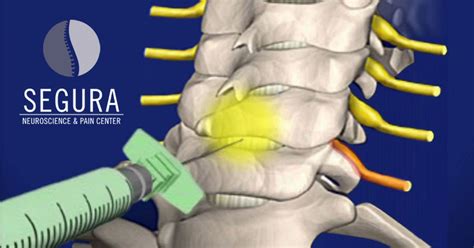 Epidural Injection Anatomy