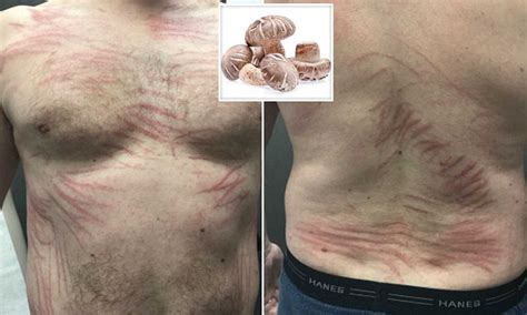 German Man Developed Severe Rash From Eating Raw Mushrooms Daily Mail
