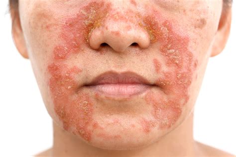 Seboroická dermatitida kožní onemocnění dermo guru