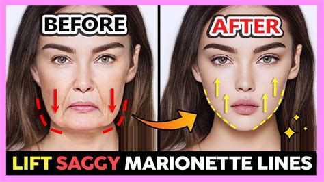 Facelift For Heavy Saggy Lower Face Massage Remove Marionette Lines And Sagging Jowls Anti