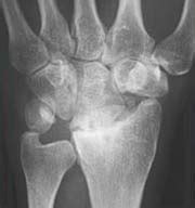 Range of motion (rom) and wrist strength (grip strength and grasp strength) were evaluated 3 and 6 weeks after surgery on the both wrists. Proximal row carpectomy vs. four-corner fusion: Patient ...