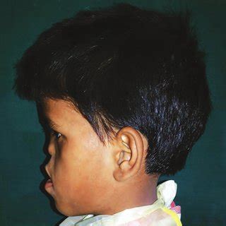 Crouzon Syndrome With Acanthosis Nigricans Female With Brachycephaly