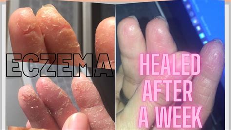 Treat Your Hand Eczema Naturally Eczema Natural Treatment Teaser