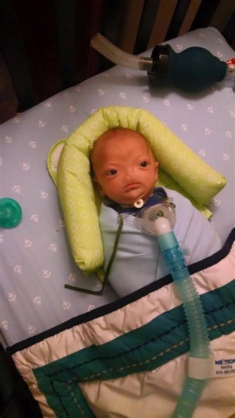 Miracle Baby Eli Thompson Who Was Born Without A Nose Dies