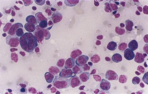 A Case Of Diffuse Large B Cell Lymphoma With Limited Amount Of