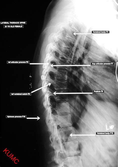 Radiographic Positioning Thoracic Positioning