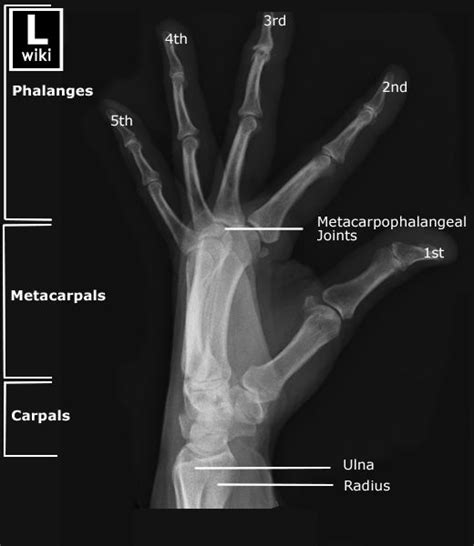 Hand Radiographic Anatomy Wikiradiography Radiology Student