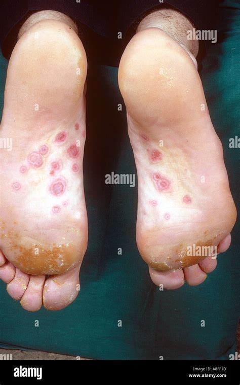 Erythema Multiforme Hi Res Stock Photography And Images Alamy
