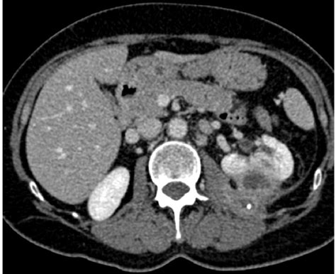 Figure 4 From The Perinephric Space And Associated Extra Renal Pathology Multi Modality Imaging