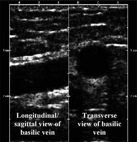 The Image Of The Basilic Vein Using A Dualimaging Ultrasound