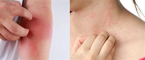 What Is Eczema And What Causes It Vedika Psoriasis Ayurveda Research
