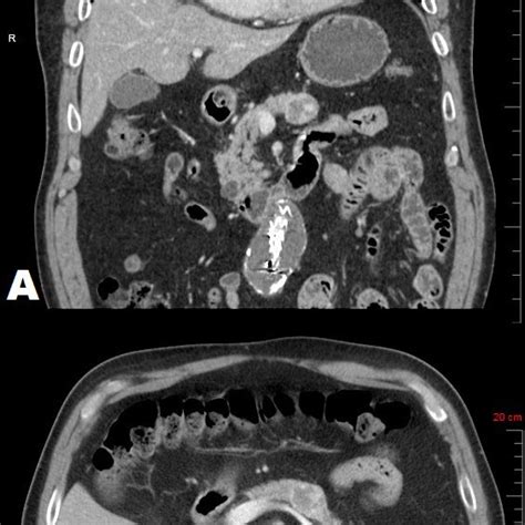 Abdominal Computed Tomography With Intravenous And Oral Contrast