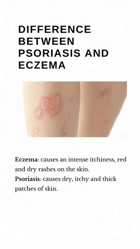 Difference Between Psoriasis And Eczema