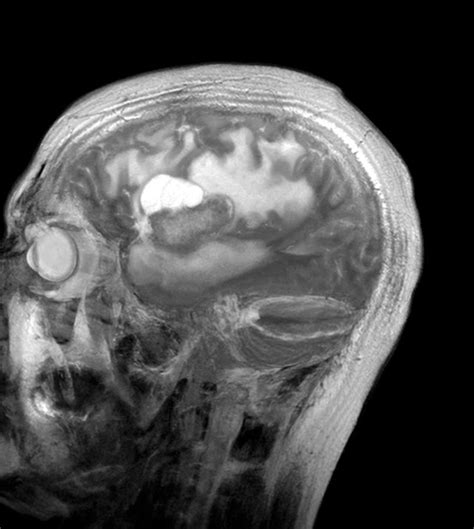 Brain Cancer Mri Scan Photograph By Du Cane Medical Imaging Ltd Pixels