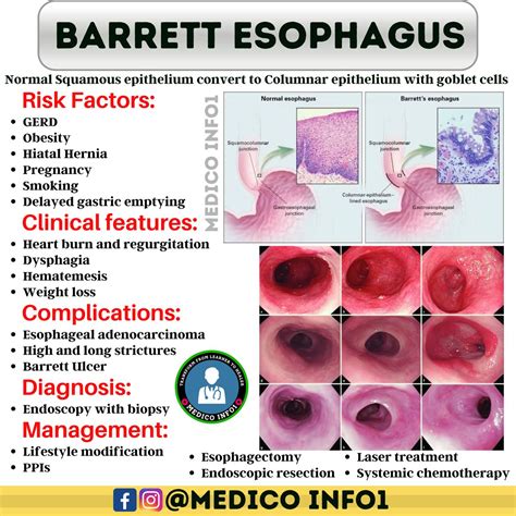 barrett s esophagus clinical features risk factors complications diagnosis management nursing