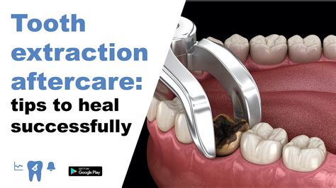 Tooth Extraction Aftercare Tips To Heal Successfully Youtube