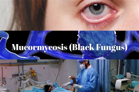 Mucormycosis Black Fungus A Threat Symptoms Prevention Treatments