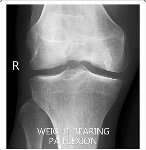 X Ray Of The Knee Showing Flattening Of The Medial Femoral Condyle And