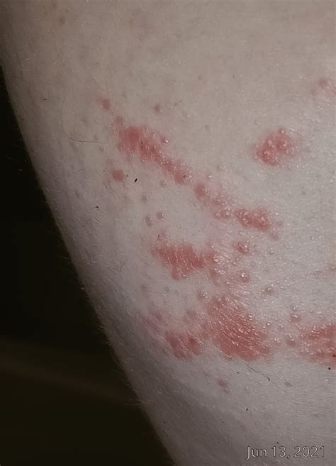 Bumpy Rash Under Armpit Is This Eczema Or Contact Dermatitis I Think