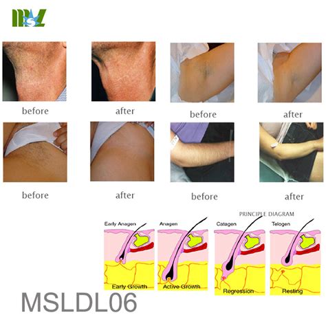 Victorian laser & skin clinic is proud to offer cheap and effective laser hair removal at our nearby melbourne clinics. Laser pubic hair removal machine MSLDL06 | Cost of laser ...
