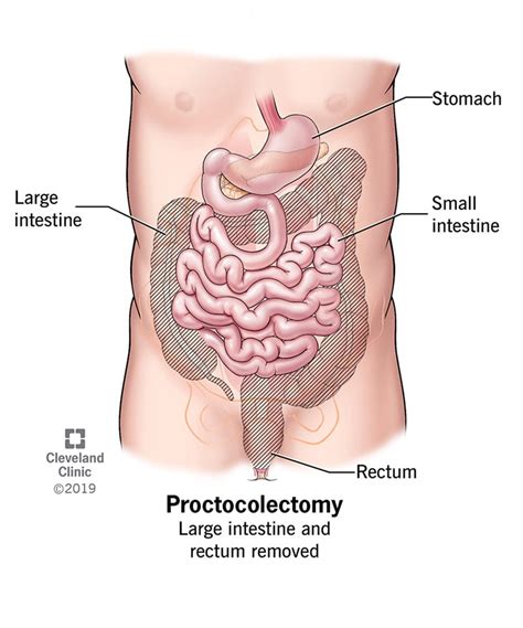 Proctocolectomy With J Pouch