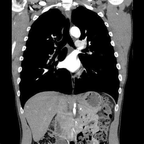 Pulmonary Sequestration And Bronchial Atresia Image