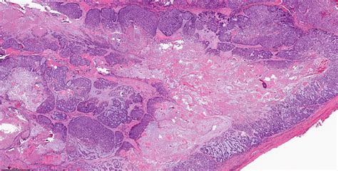 Pathology Outlines Myoepithelial Carcinoma