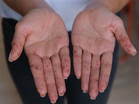 Hand Foot And Mouth Disease In Adults Symptoms And Treatment