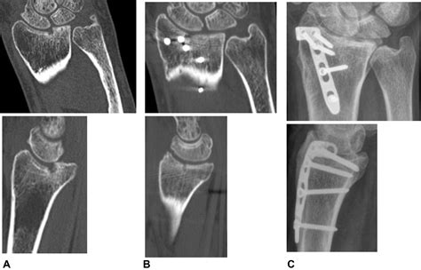 Intermediate Term Outcome Of 3 Dimensional Corrective Osteotomy For