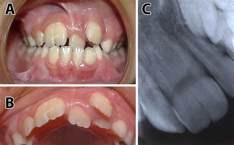 Autotransplantation Of A Supernumerary Incisor As A Replacement For