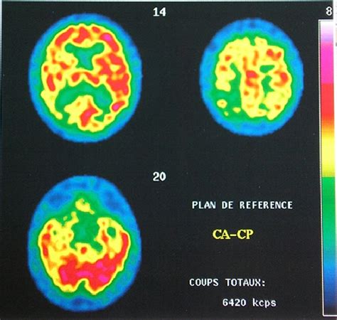 Perfusion Brain Scintigraphy With 99mtc Severe Hypoperfusion Of The