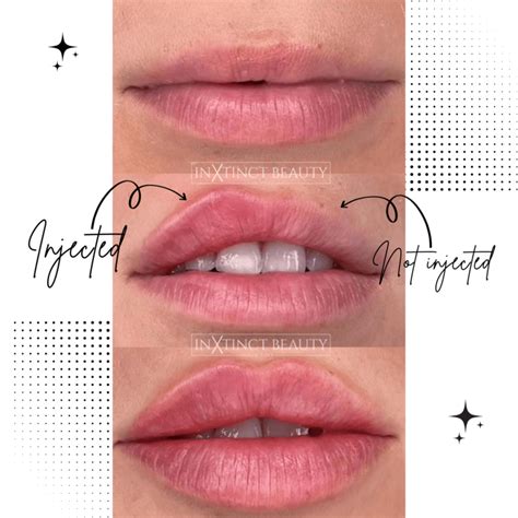 Russian Lip Technique Lip Augmentation Lip Filler Nyc